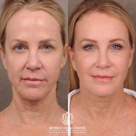 Beverly Hills Center Female Patient Before and After AuraLyft, Brow Lift, Upper Blepharoplasty