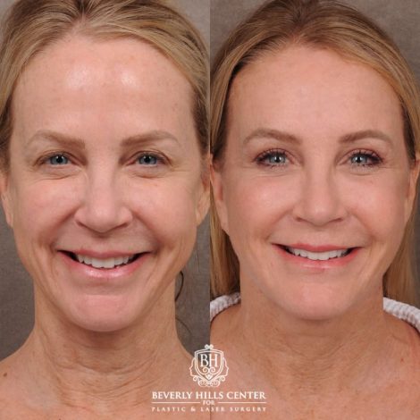Beverly Hills Center Female Patient Before and After AuraLyft, Brow Lift, Upper Blepharoplasty