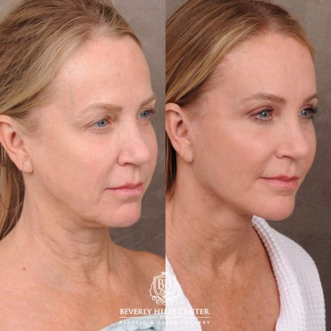 Beverly Hills Center Female Patient Before and After AuraLyft, Brow Lift, Upper Blepharoplasty