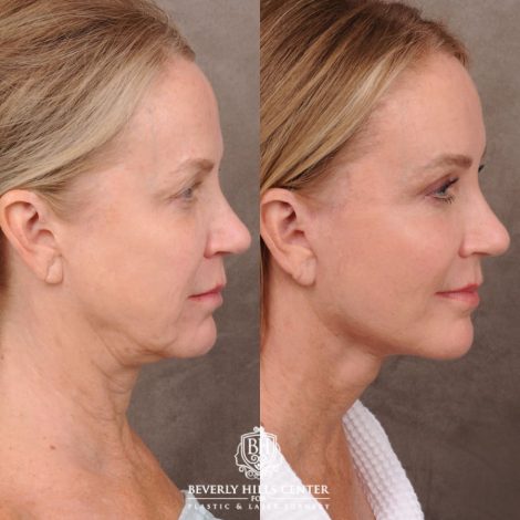 Beverly Hills Center Female Patient Before and After AuraLyft, Brow Lift, Upper Blepharoplasty