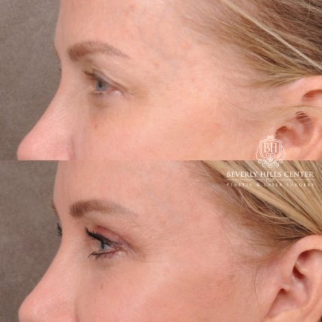 Beverly Hills Center Female Patient Before and After AuraLyft, Brow Lift, Upper Blepharoplasty