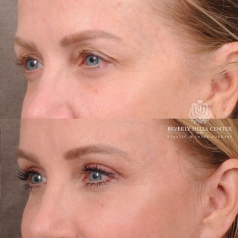Beverly Hills Center Female Patient Before and After AuraLyft, Brow Lift, Upper Blepharoplasty