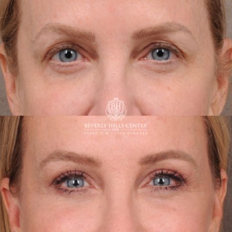 Beverly Hills Center Female Patient Before and After AuraLyft, Brow Lift, Upper Blepharoplasty