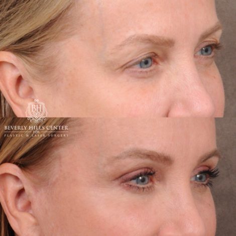 Beverly Hills Center Female Patient Before and After AuraLyft, Brow Lift, Upper Blepharoplasty