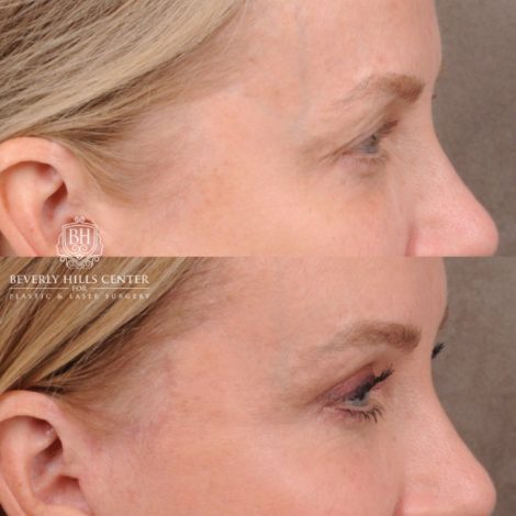 Beverly Hills Center Female Patient Before and After AuraLyft, Brow Lift, Upper Blepharoplasty