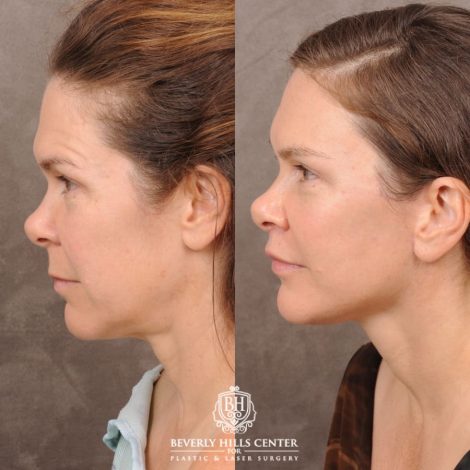 Beverly Hills Center Female Patient Before and After Comprehensive AuraLyft featuring CUPID LIFT® Lip Lift, Brow Lift, Upper Blepharoplasty, and Ptosis Repair