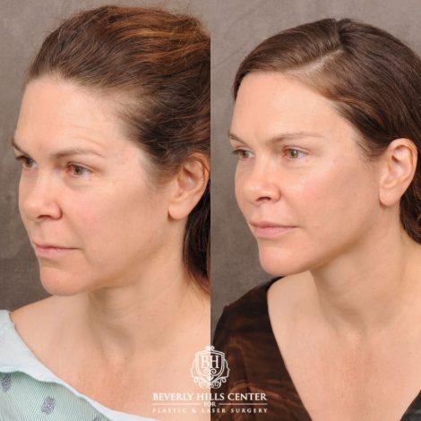 Beverly Hills Center Female Patient Before and After Comprehensive AuraLyft featuring CUPID LIFT® Lip Lift, Brow Lift, Upper Blepharoplasty, and Ptosis Repair