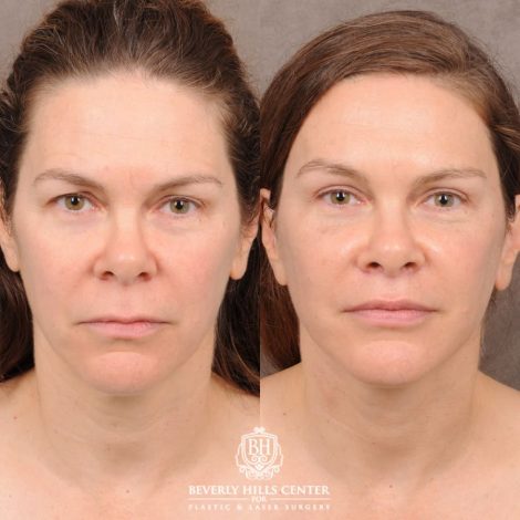 Beverly Hills Center Female Patient Before and After Comprehensive AuraLyft featuring CUPID LIFT® Lip Lift, Brow Lift, Upper Blepharoplasty, and Ptosis Repair