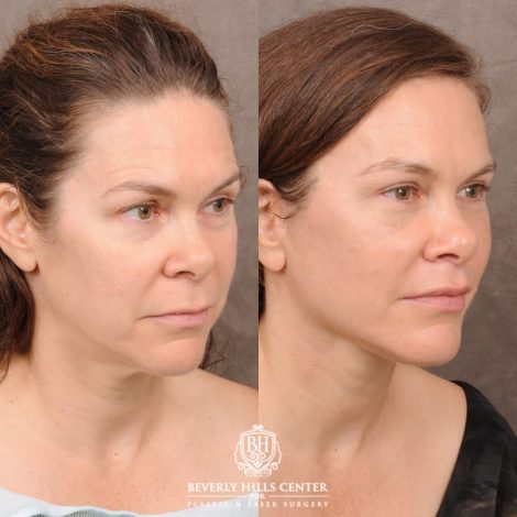 Beverly Hills Center Female Patient Before and After Comprehensive AuraLyft featuring CUPID LIFT® Lip Lift, Brow Lift, Upper Blepharoplasty, and Ptosis Repair