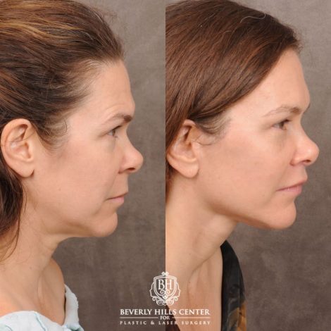 Beverly Hills Center Female Patient Before and After Comprehensive AuraLyft featuring CUPID LIFT® Lip Lift, Brow Lift, Upper Blepharoplasty, and Ptosis Repair
