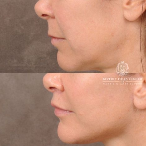 Beverly Hills Center Female Patient Before and After Comprehensive AuraLyft featuring CUPID LIFT® Lip Lift, Brow Lift, Upper Blepharoplasty, and Ptosis Repair