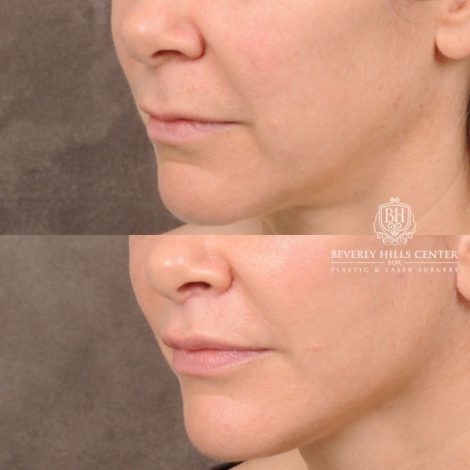 Beverly Hills Center Female Patient Before and After Comprehensive AuraLyft featuring CUPID LIFT® Lip Lift, Brow Lift, Upper Blepharoplasty, and Ptosis Repair