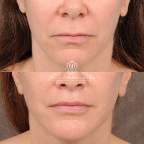 Beverly Hills Center Female Patient Before and After Comprehensive AuraLyft featuring CUPID LIFT® Lip Lift, Brow Lift, Upper Blepharoplasty, and Ptosis Repair