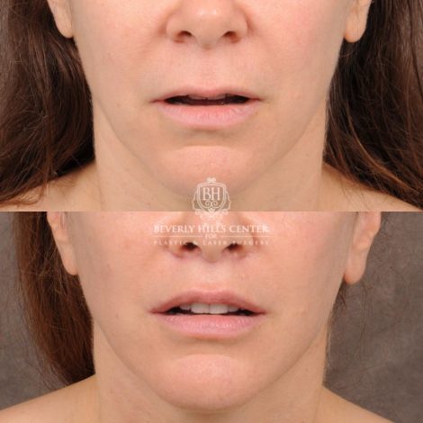 Beverly Hills Center Female Patient Before and After Comprehensive AuraLyft featuring CUPID LIFT® Lip Lift, Brow Lift, Upper Blepharoplasty, and Ptosis Repair