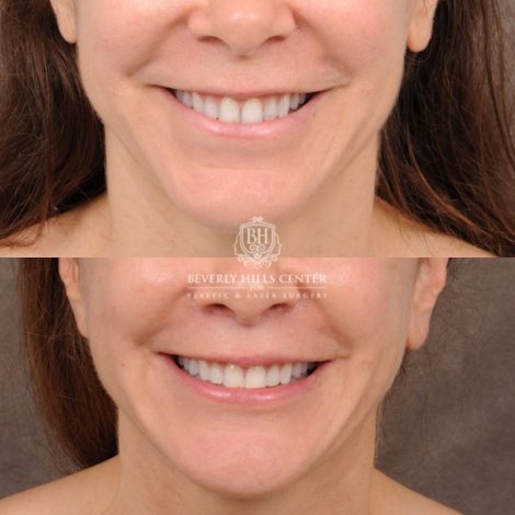 Beverly Hills Center Female Patient Before and After Comprehensive AuraLyft featuring CUPID LIFT® Lip Lift, Brow Lift, Upper Blepharoplasty, and Ptosis Repair