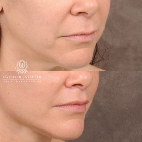 Beverly Hills Center Female Patient Before and After Comprehensive AuraLyft featuring CUPID LIFT® Lip Lift, Brow Lift, Upper Blepharoplasty, and Ptosis Repair