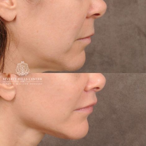 Beverly Hills Center Female Patient Before and After Comprehensive AuraLyft featuring CUPID LIFT® Lip Lift, Brow Lift, Upper Blepharoplasty, and Ptosis Repair
