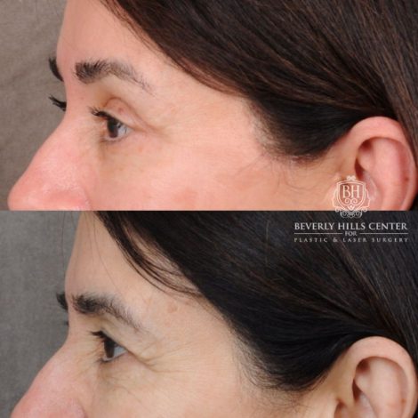 Beverly Hills Center Female Patient Before and After AuraLyft, Brow Lift, Upper Blepharoplasty, Ptosis Repair