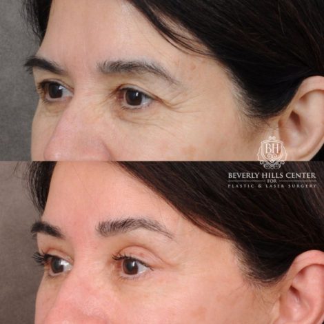 Beverly Hills Center Female Patient Before and After AuraLyft, Brow Lift, Upper Blepharoplasty, Ptosis Repair