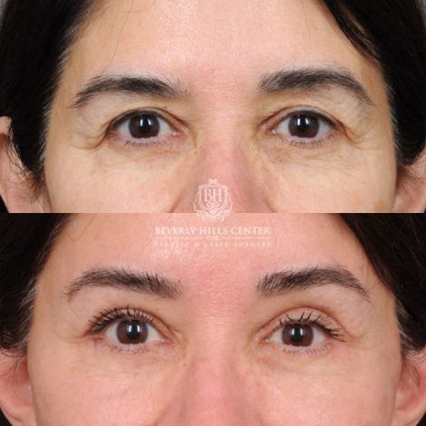 Beverly Hills Center Female Patient Before and After AuraLyft, Brow Lift, Upper Blepharoplasty, Ptosis Repair