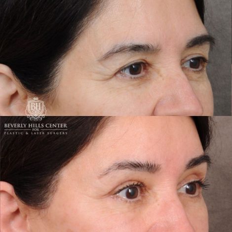 Beverly Hills Center Female Patient Before and After AuraLyft, Brow Lift, Upper Blepharoplasty, Ptosis Repair