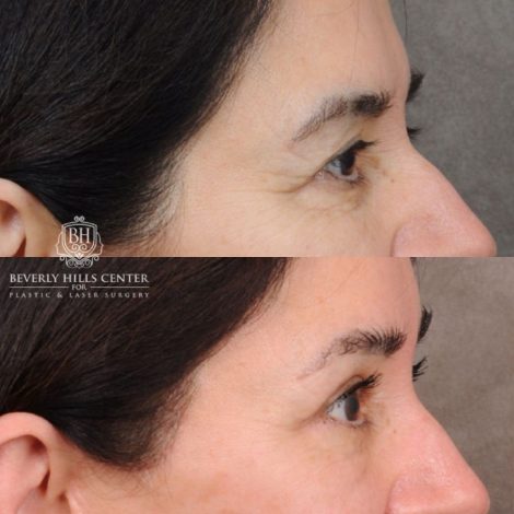 Beverly Hills Center Female Patient Before and After AuraLyft, Brow Lift, Upper Blepharoplasty, Ptosis Repair
