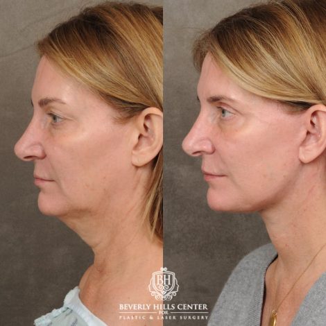 Beverly Hills Center Female Patient Before and After AuraLyft, Upper Blepharoplasty, TCA Peel