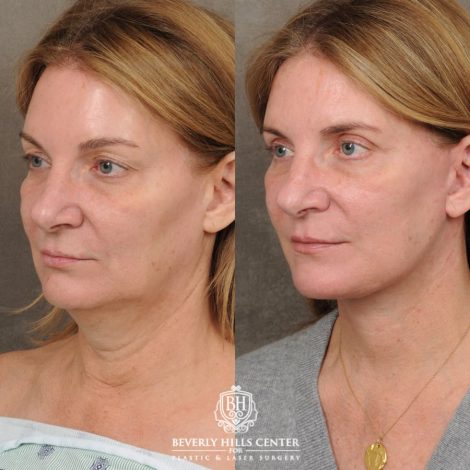 Beverly Hills Center Female Patient Before and After AuraLyft, Upper Blepharoplasty, TCA Peel