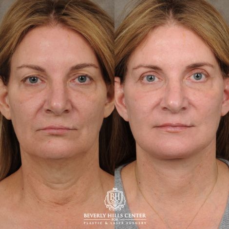 Beverly Hills Center Female Patient Before and After AuraLyft, Upper Blepharoplasty, TCA Peel