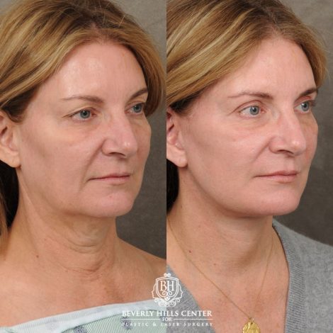 Beverly Hills Center Female Patient Before and After AuraLyft, Upper Blepharoplasty, TCA Peel