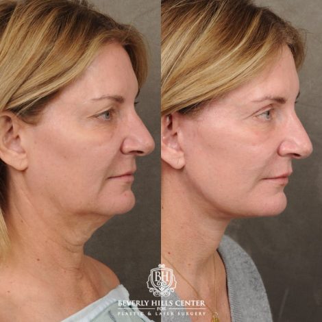 Beverly Hills Center Female Patient Before and After AuraLyft, Upper Blepharoplasty, TCA Peel