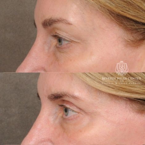 Beverly Hills Center Female Patient Before and After AuraLyft, Upper Blepharoplasty, TCA Peel