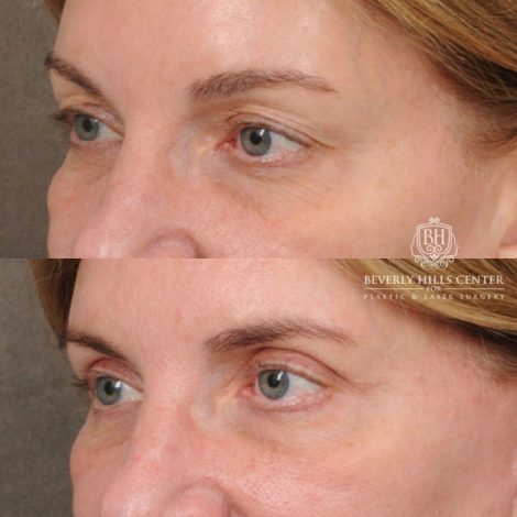 Beverly Hills Center Female Patient Before and After AuraLyft, Upper Blepharoplasty, TCA Peel
