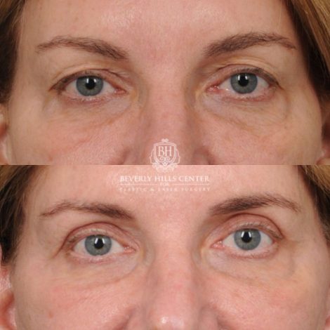 Beverly Hills Center Female Patient Before and After AuraLyft, Upper Blepharoplasty, TCA Peel