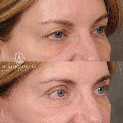 Beverly Hills Center Female Patient Before and After AuraLyft, Upper Blepharoplasty, TCA Peel