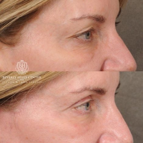 Beverly Hills Center Female Patient Before and After AuraLyft, Upper Blepharoplasty, TCA Peel