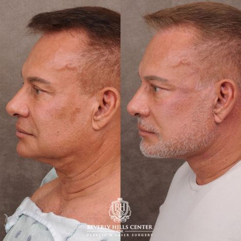 Beverly Hills Center Female Patient Before and After AuraLyft