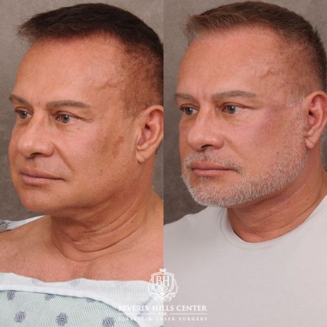 Beverly Hills Center Female Patient Before and After AuraLyft