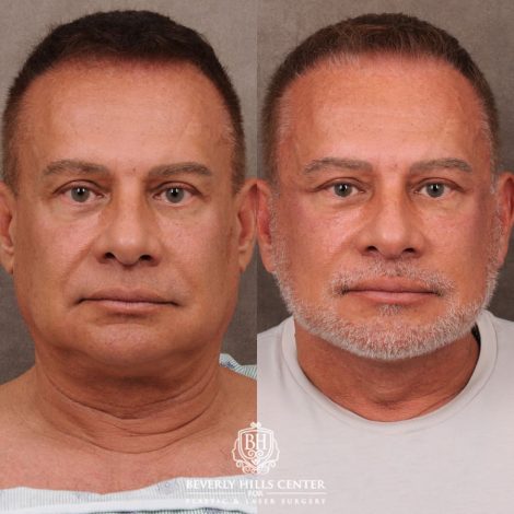 Beverly Hills Center Female Patient Before and After AuraLyft