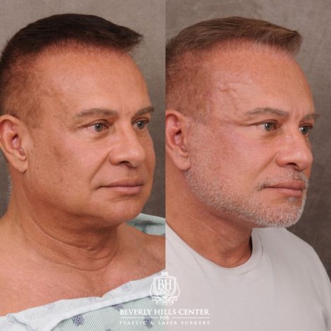 Beverly Hills Center Female Patient Before and After AuraLyft