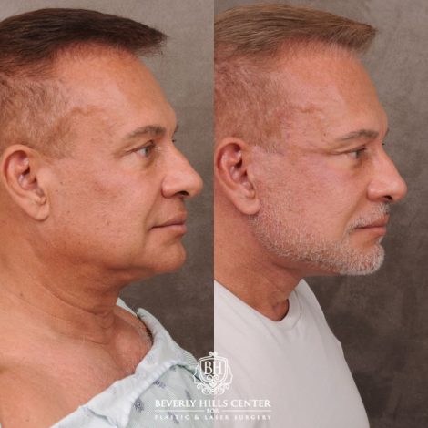 Beverly Hills Center Female Patient Before and After AuraLyft