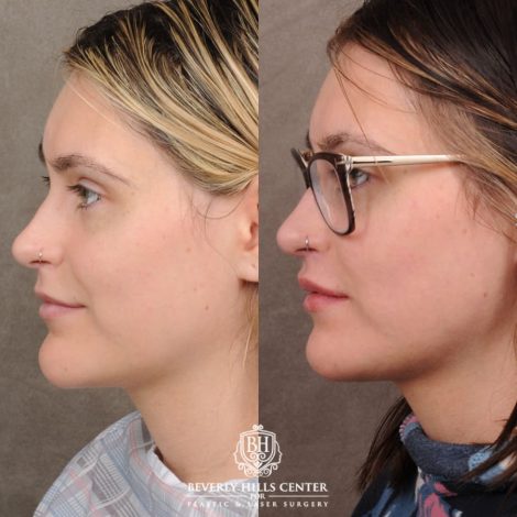 Beverly Hills Center Female Patient Before and After CUPID LIFT® with Chin Revision