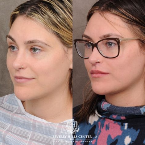 Beverly Hills Center Female Patient Before and After CUPID LIFT® with Chin Revision