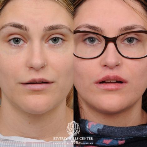 Beverly Hills Center Female Patient Before and After CUPID LIFT® with Chin Revision