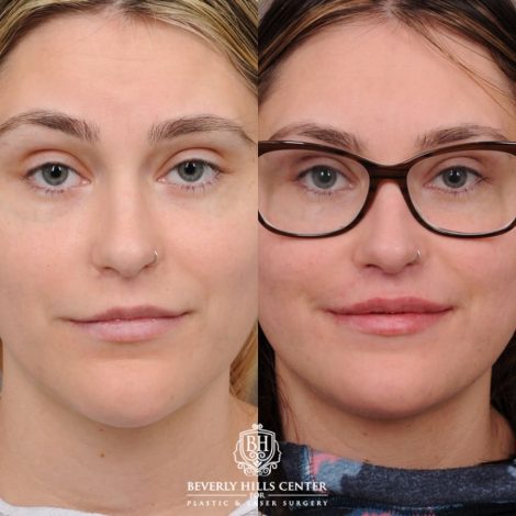 Beverly Hills Center Female Patient Before and After CUPID LIFT® with Chin Revision
