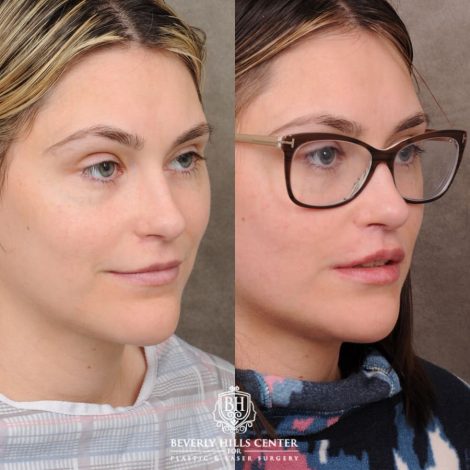 Beverly Hills Center Female Patient Before and After CUPID LIFT® with Chin Revision