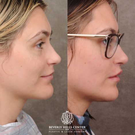 Beverly Hills Center Female Patient Before and After CUPID LIFT® with Chin Revision