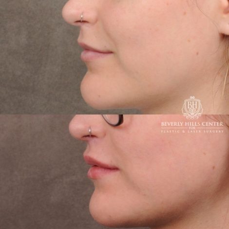 Beverly Hills Center Female Patient Before and After CUPID LIFT® with Chin Revision
