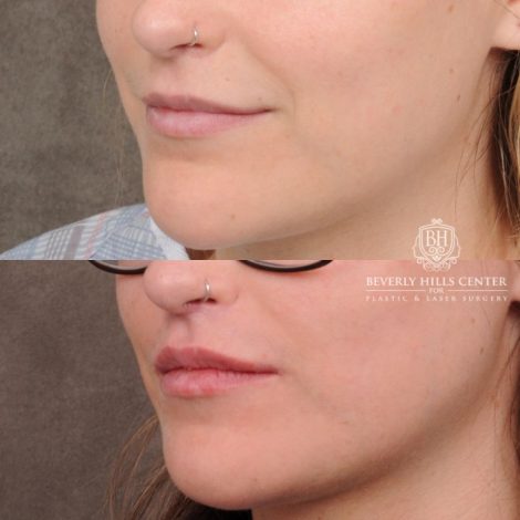 Beverly Hills Center Female Patient Before and After CUPID LIFT® with Chin Revision