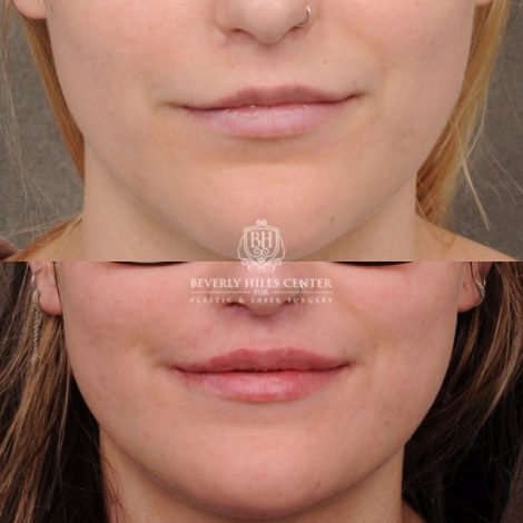 Beverly Hills Center Female Patient Before and After CUPID LIFT® with Chin Revision